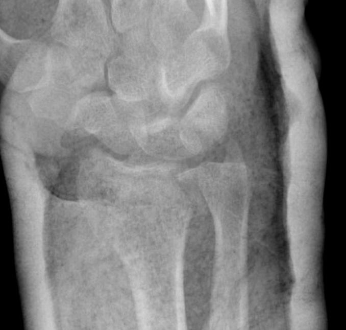 DRUJ Fracture